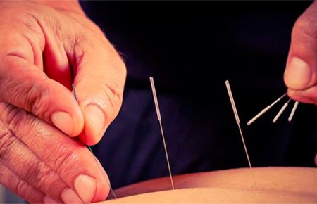 acupuntura